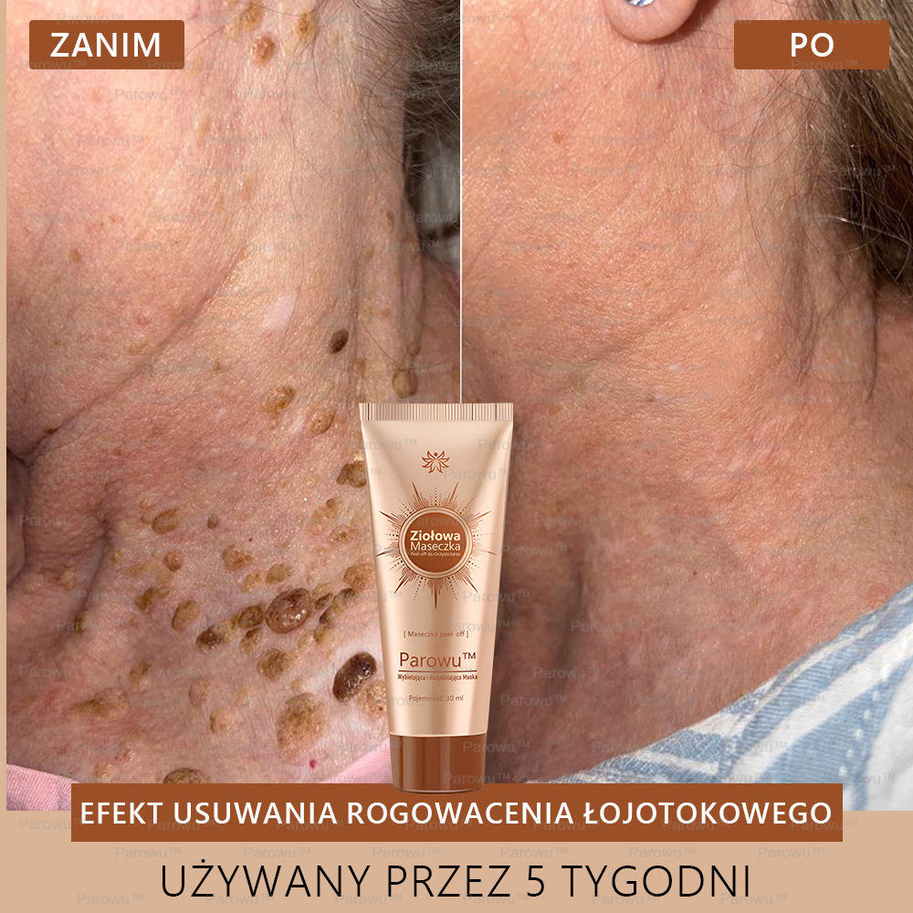 ☀️🌙Parowu™ Wybielająca i Rozjaśniająca Maska - Naturalne składniki trwale usuwają plamy, piegi i przebarwienia