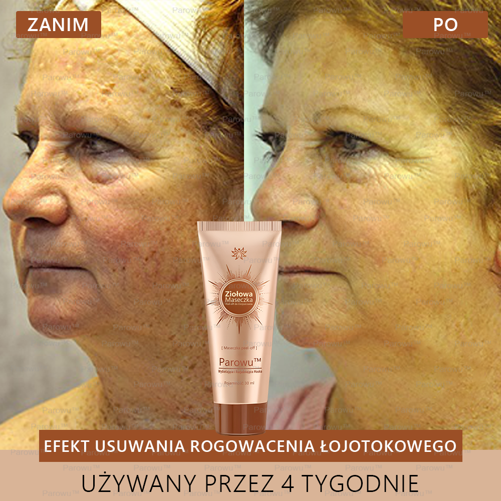 ☀️🌙Parowu™ Wybielająca i Rozjaśniająca Maska - Naturalne składniki trwale usuwają plamy, piegi i przebarwienia